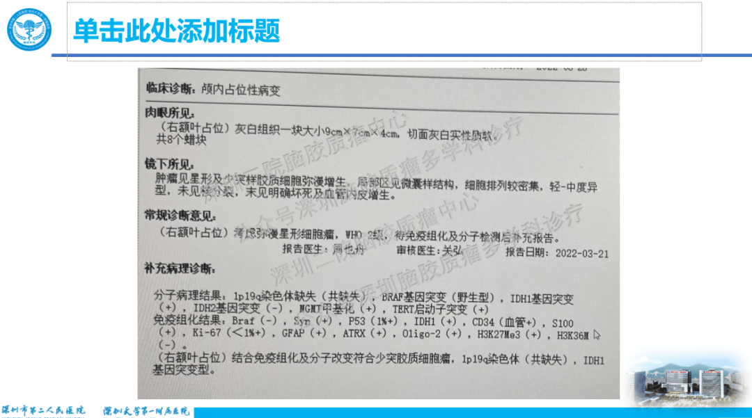 会议报道2022年4月期深圳二院疑难脑胶质瘤mdt简报