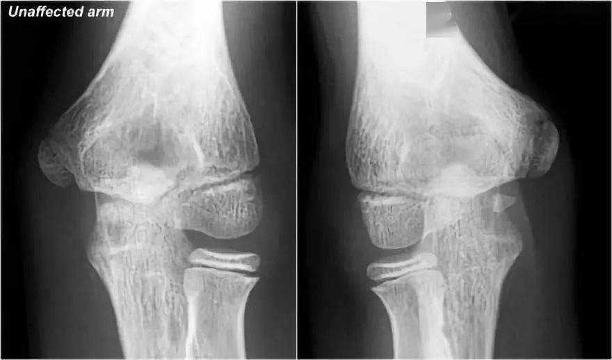 little leaguer的肘部也被称为内侧性上睑下垂,有些人称之为骨骺溶解.