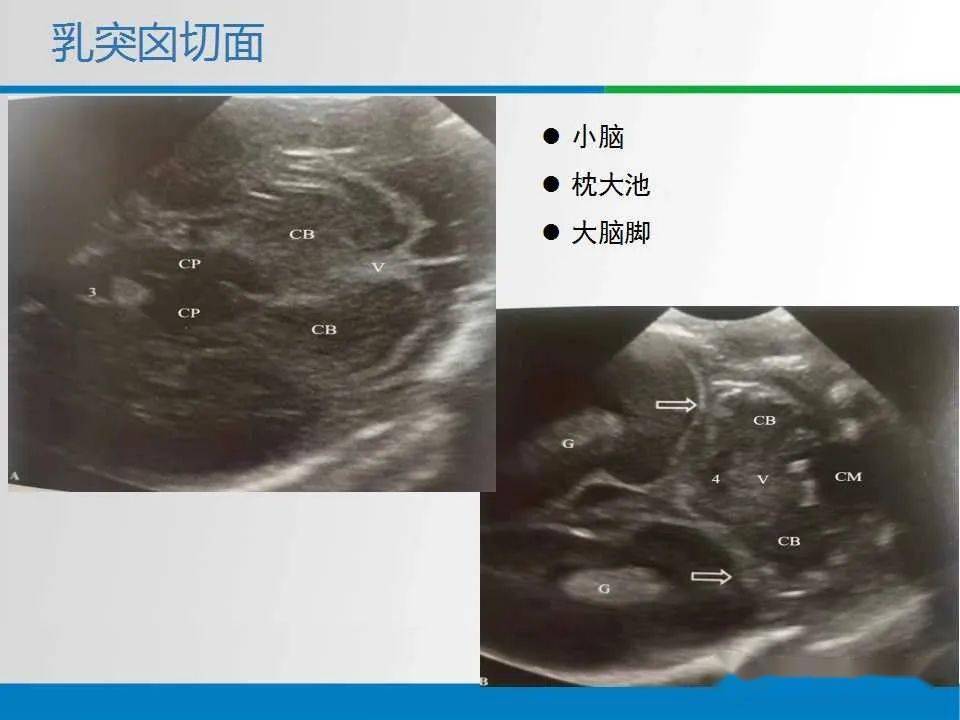 文献复习与病例讨论61新生儿颅脑超声解剖