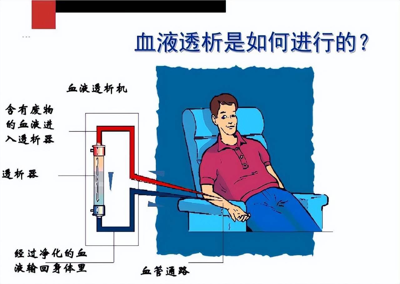经常需要肾脏替代疗法,如血液透析和腹膜透析,有些患者还可以进行肾