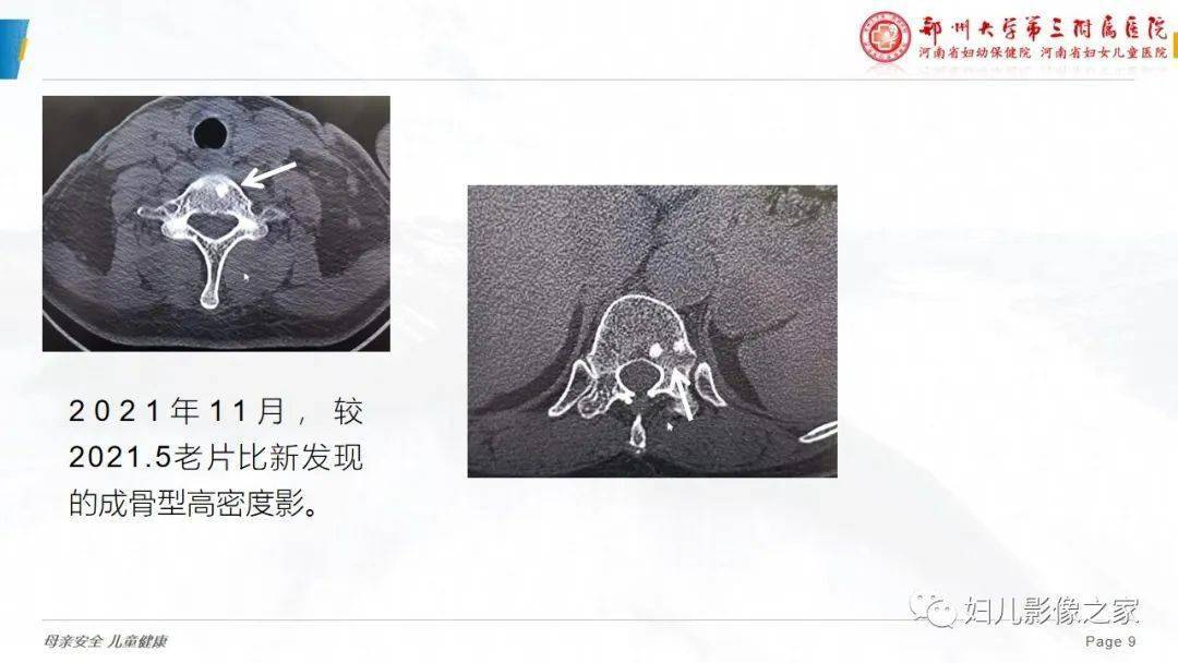 乳腺癌骨转移假性进展您了解吗?