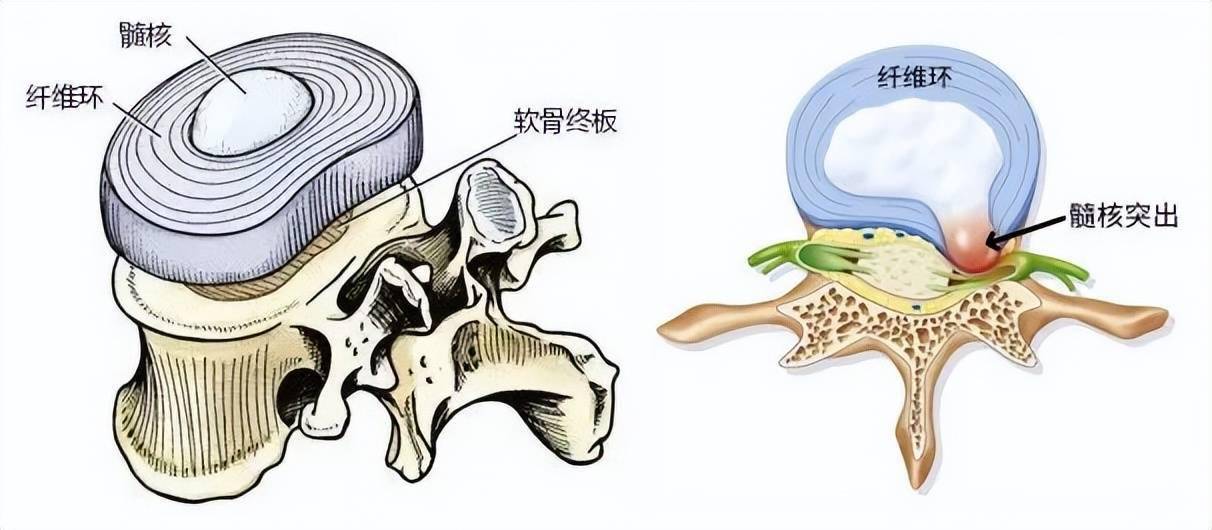 王文军教授解释说:腰椎间盘由髓核,纤维环,软骨板组