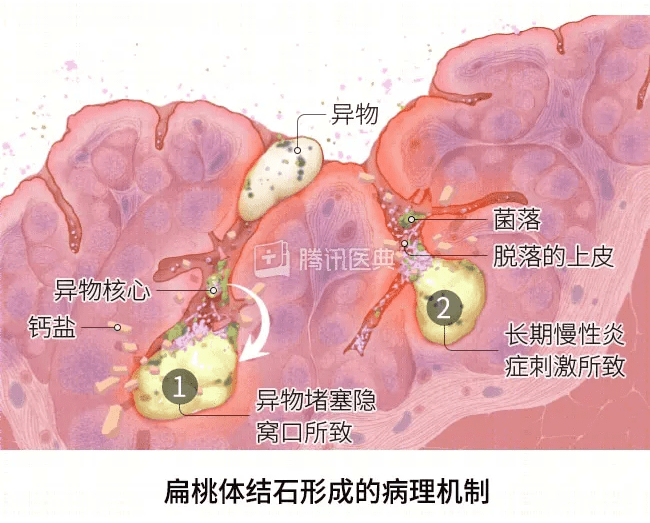 扁桃体分泌物图片