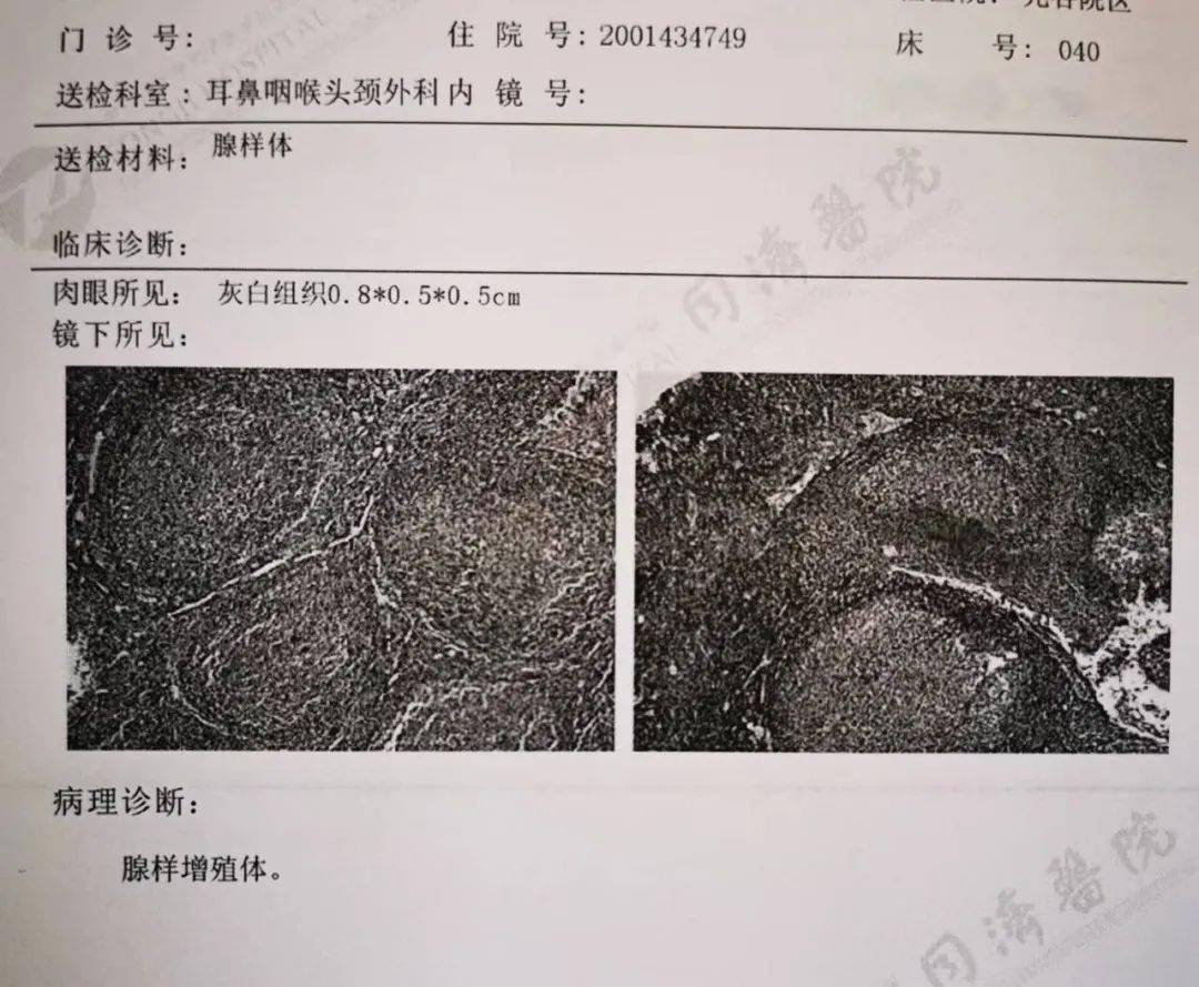 保守治疗1年多吃尽苦头,孩子的腺样体手术我真后悔切晚了