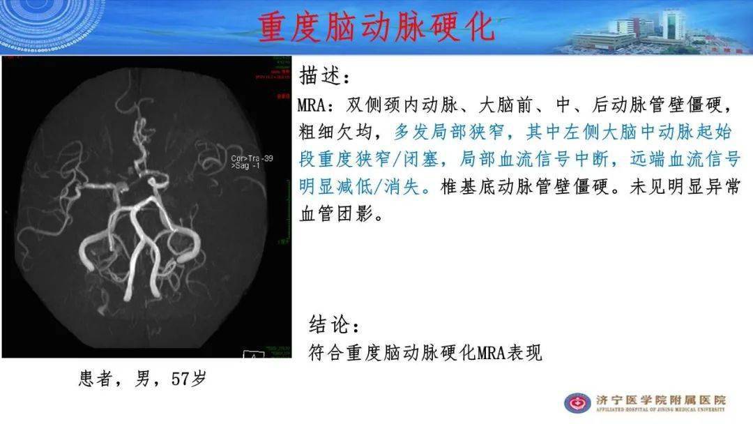 顱腦mra診斷要點及報告模板