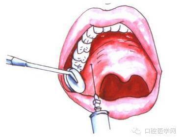 口腔颌面外科常用麻醉方法图谱