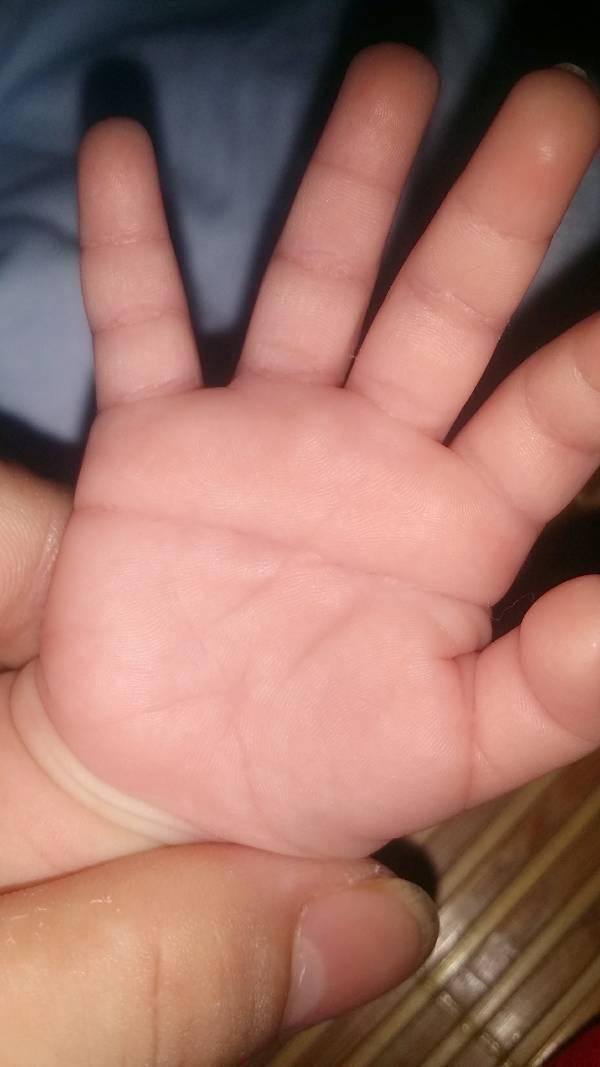 鱼鳞病婴儿的手图片