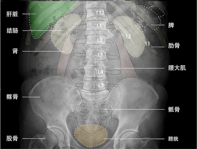 肠梗阻平片图讲解图片