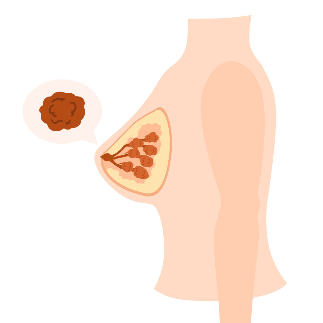 标准建议,乳腺癌高风险人群宜从40岁开始进行筛查,每年进行一次乳腺