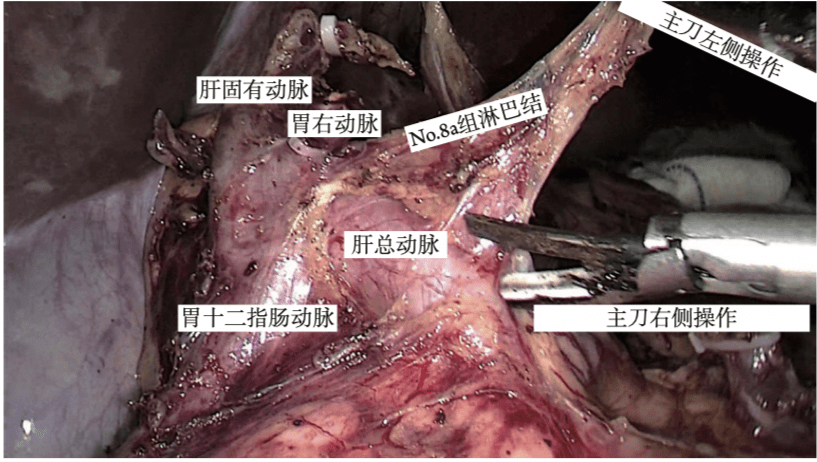 9组淋巴结,并显露胃左动脉(lga)根部,先绕过lga清扫其根部周围的no.