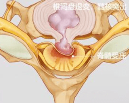 什麼樣的情況是頸椎病?_壓迫_症狀_上肢