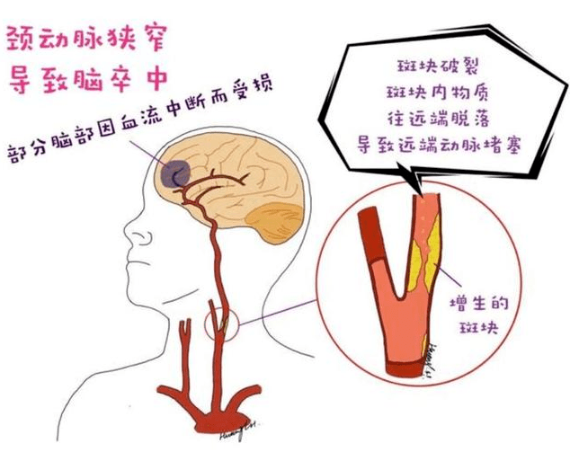 頸動脈發現斑塊嚴重嗎是否需要治療