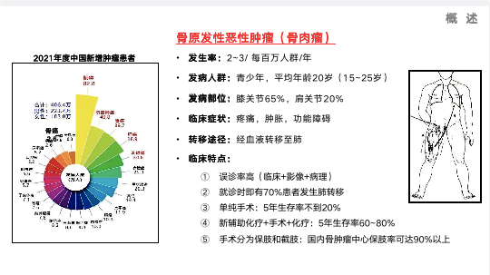 骨肉瘤发病率图片