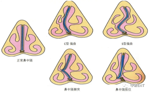 黏膜接觸點痛,是由於鼻腔解剖變異引起,主要包括中鼻甲氣房以及鼻中隔