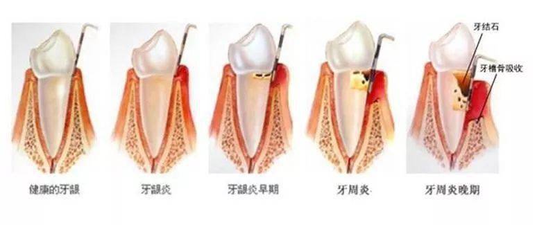 牙齦出現白膿包你以為只是發炎嗎