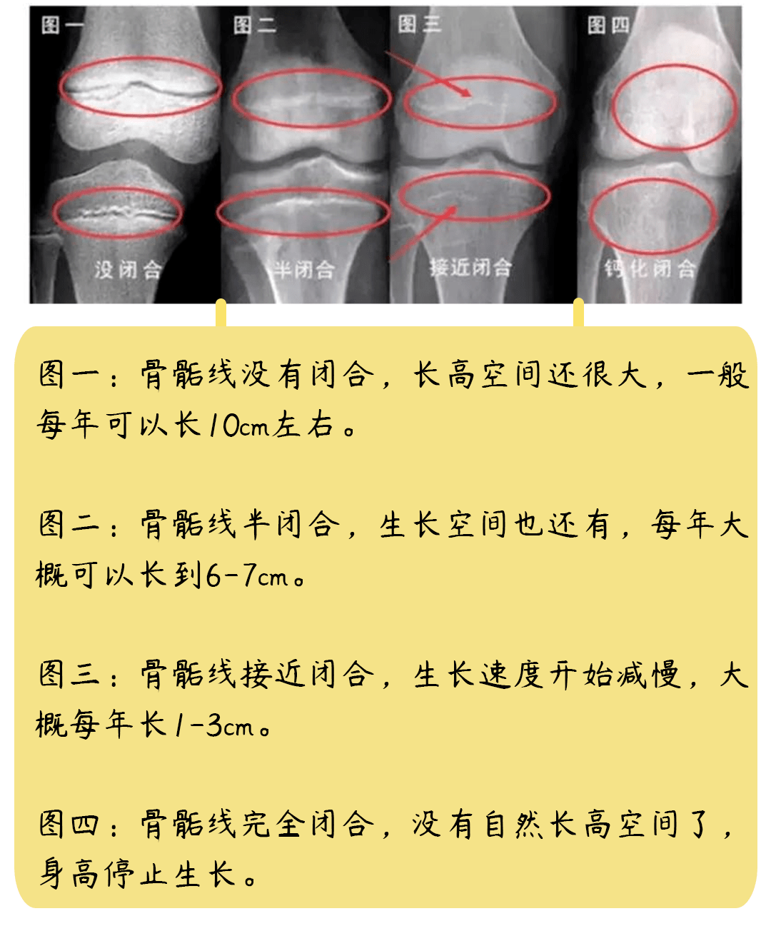 性早熟孩子的骨骼会进入快速增长阶段