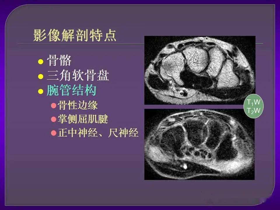 拇长屈肌腱解剖图mri图片