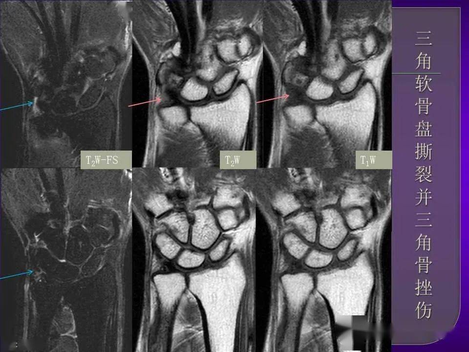 详细篇腕关节解剖及常见病变mri表现