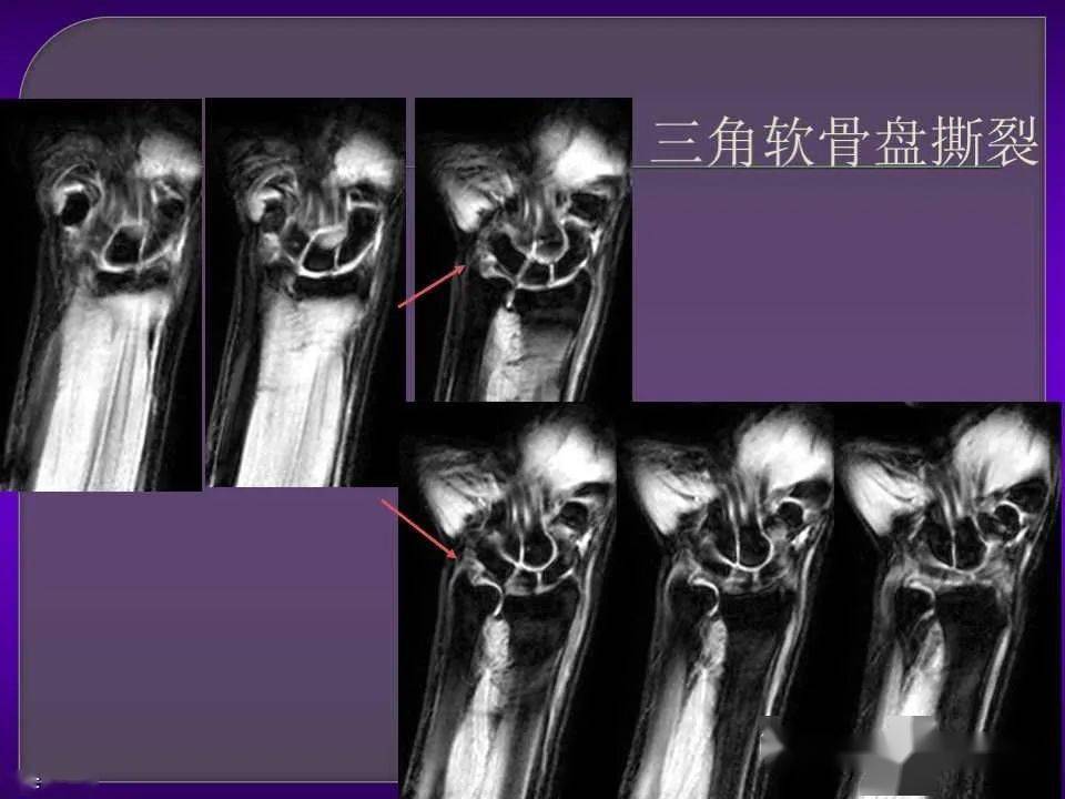 詳細篇腕關節解剖及常見病變mri表現