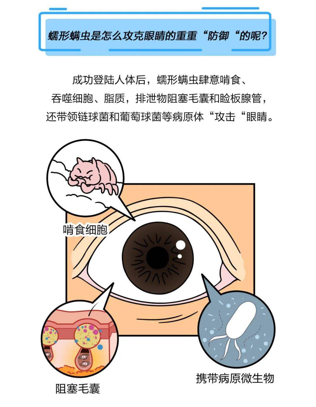 怀化爱尔眼科医院角膜及眼表科主任向梅表示,毛囊蠕形螨还是皮脂蠕形