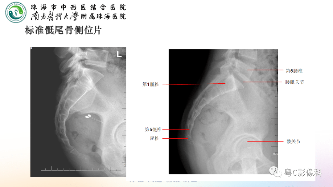 骶尾骨正侧位x线摄影