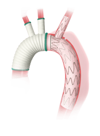 中山医院心外科团队成功完成全国首例国产新型主动脉术中支架植入