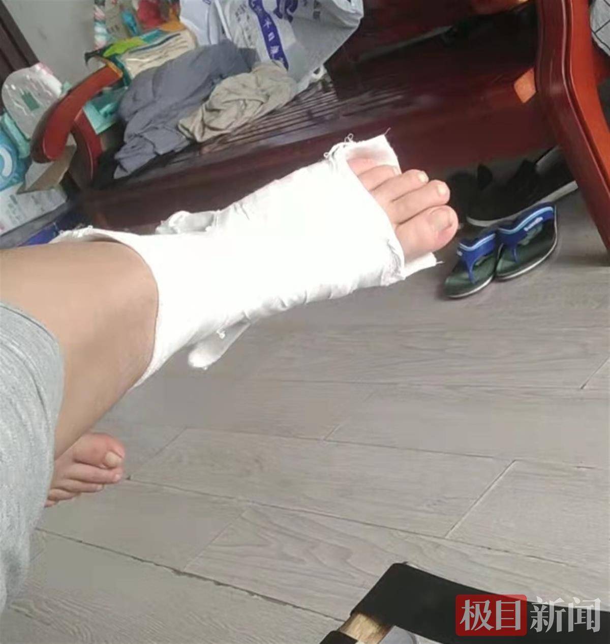 左腿肿胀扎了几针放点血！杭州45岁男子差点毁了这条腿！_男人_长沙社区通