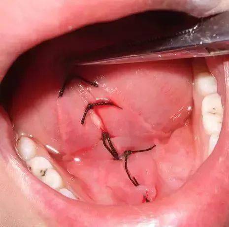 剪舌筋该不该让孩子挨这一刀