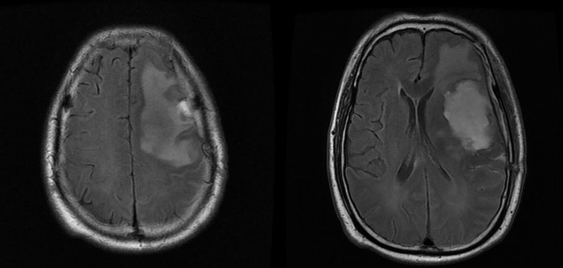 爱见新生一例胶质母细胞瘤患者who4级术后辅助tmz联合肿瘤电场治疗总