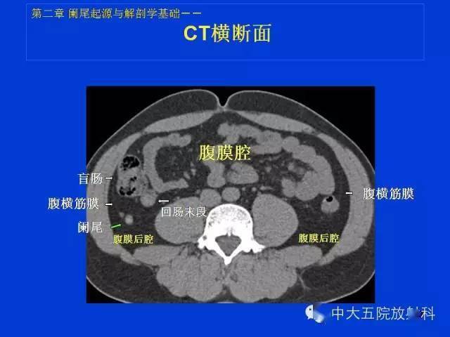 阑尾ct图解图像图片