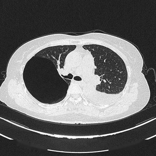 肺大泡ct图片 肺大疱图片