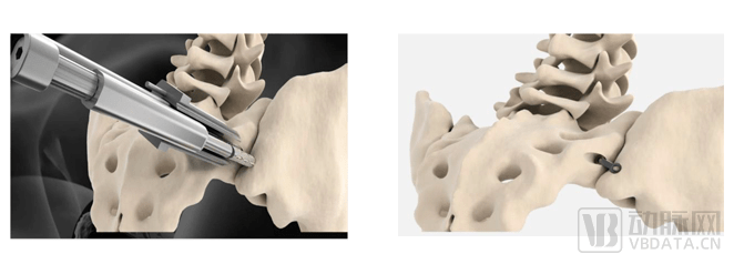 骶髂關節融合手術植入系統fda獲批tenonmedical完成ipo