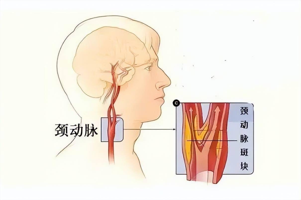 頸動脈支架植入術為69歲患者打通大腦生命線