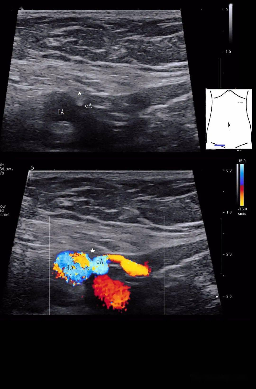 腹腔大血管解剖图超声图片