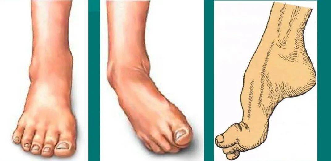足内翻最常见的表现就是前中足的内收内旋,高弓,马蹄,如果这么表现的