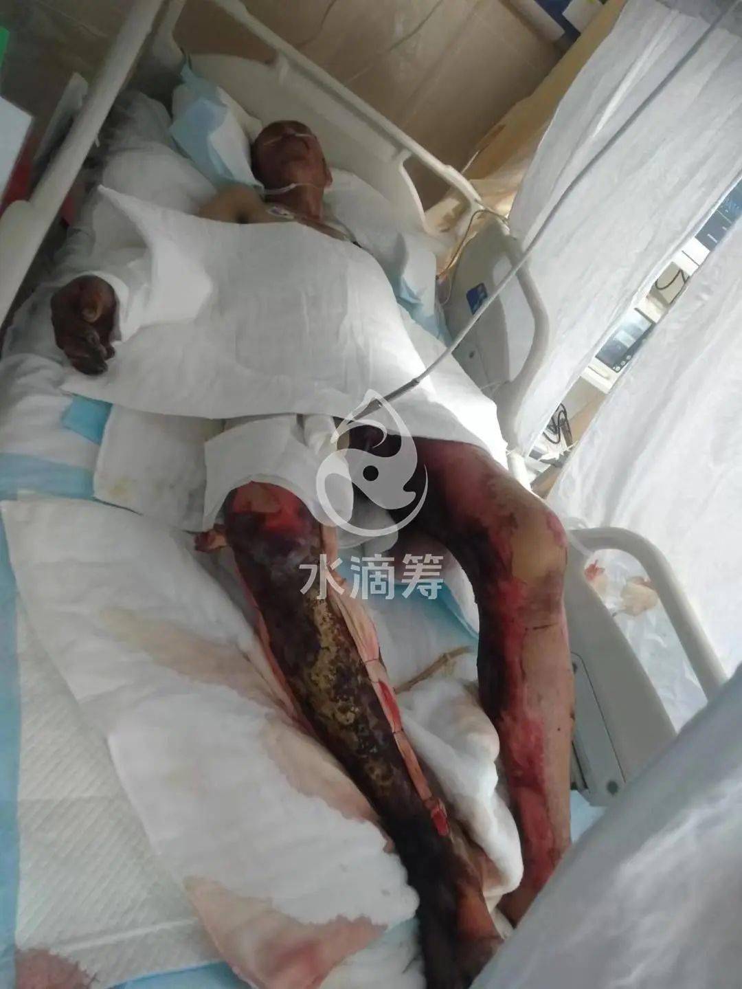 可怜会泽一男子因大火烧成重伤