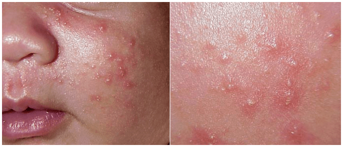 10种皮疹特点分布治疗一网打尽帮你练就火眼金睛