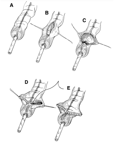 陈先生_手术_患者