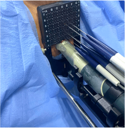 浙大一院首例超声引导下经会阴前列腺癌不可逆电穿孔消融术