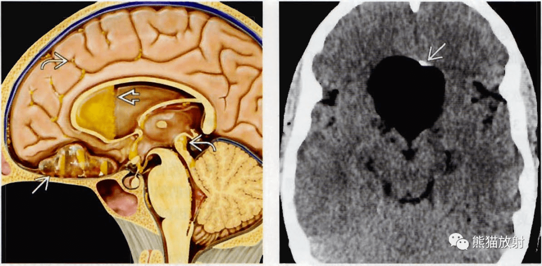 胶样囊肿皮样囊肿表皮样囊肿影像诊断要点总结