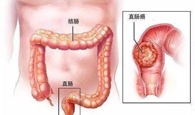 直肠癌长在什么位置图片