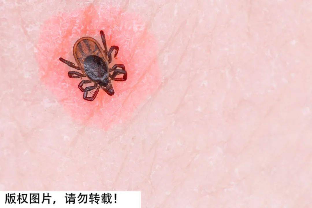 3人去世这病可quot人传人quot近期高发千万要小心