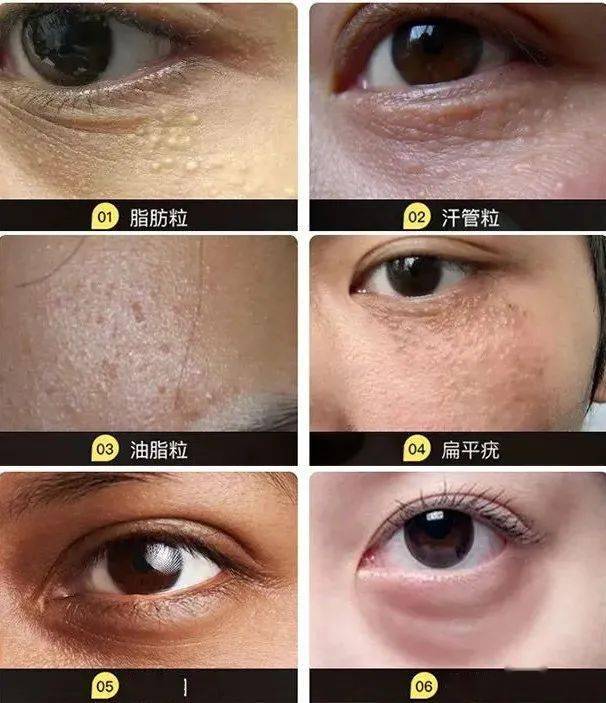 长了脂肪粒到底挤不挤一分钟教你处理它的正确姿势