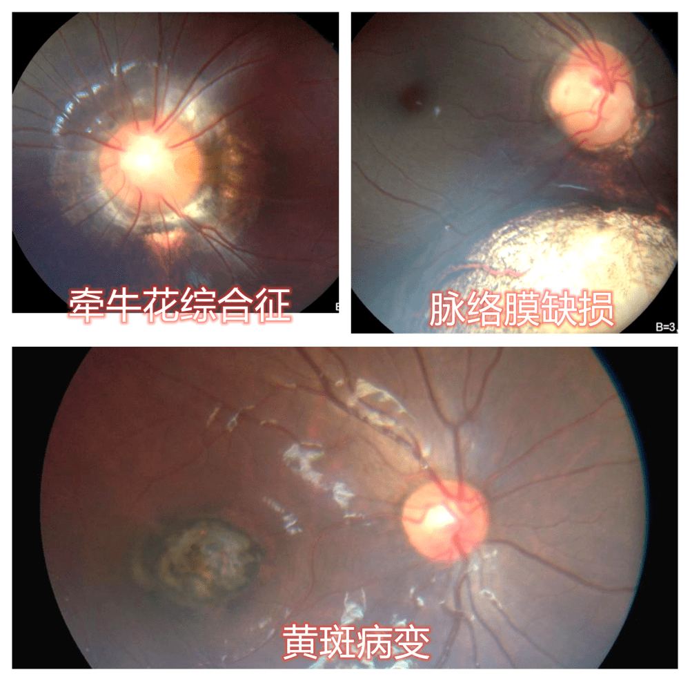 除了孩子眼保健需要篩查眼底,還有一些先天性眼底病變也是可以通過