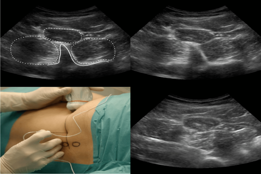 神经阻滞丨超声引导下腰丛及其分支神经阻滞