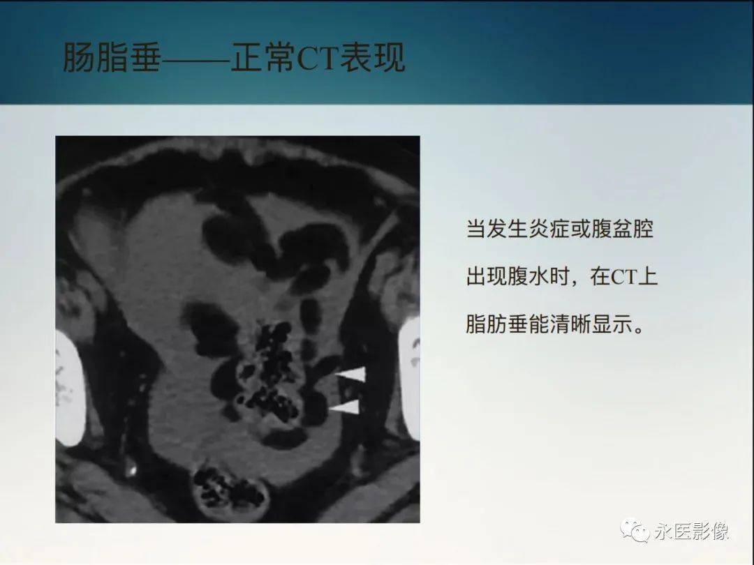 急性原发性肠脂垂炎的影像学表现_病变_永医_腹股沟