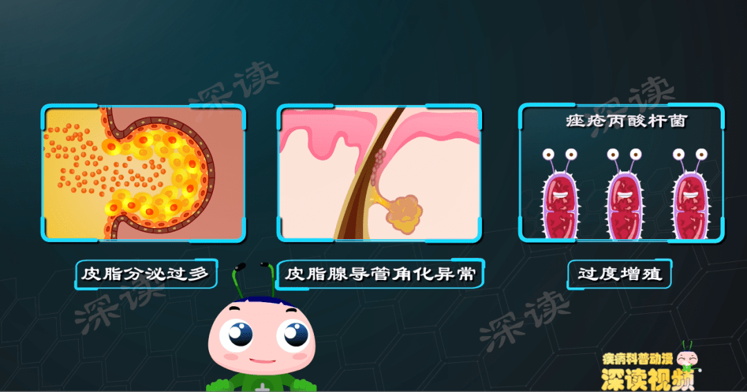 痤疮是一种多因素导致的疾病,比如皮脂分泌过多,皮脂腺导管角化异常