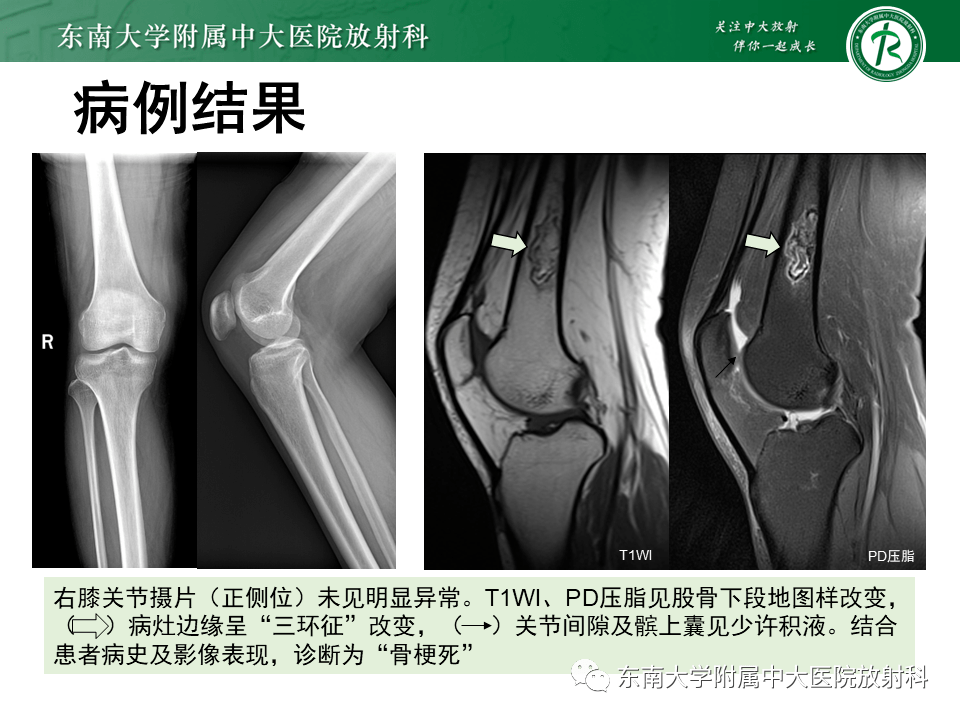 骨梗死影像表现