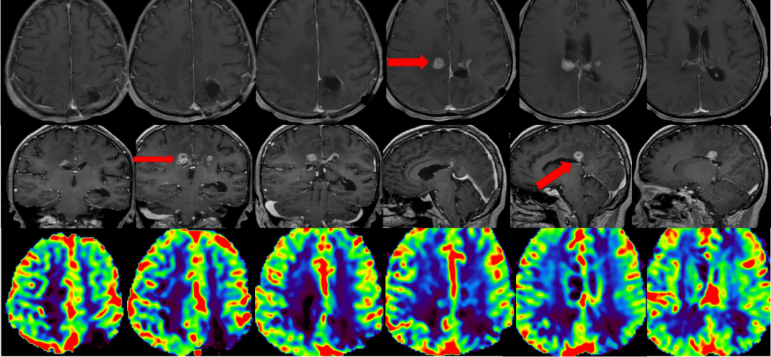 爱见新生一例胶质母细胞瘤who4级idh野生型术后使用ttfields治疗总