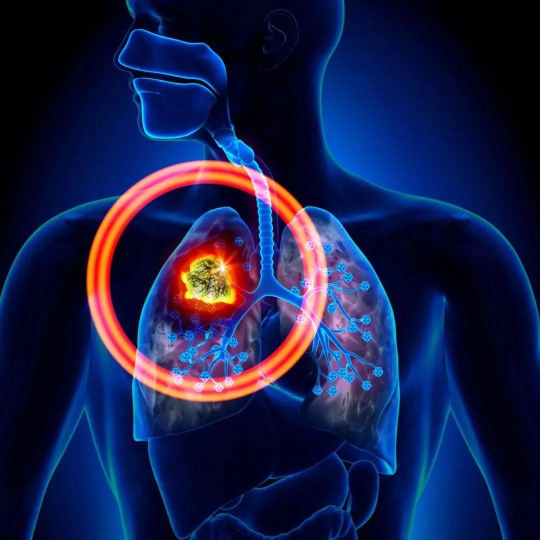 肺癌的四个阶段. 向量例证. 插画 包括有 内部, 人力, 关心, 健康, 尼古丁, 查出, 呼吸, 养殖 - 193335895